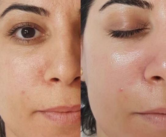 Before & After